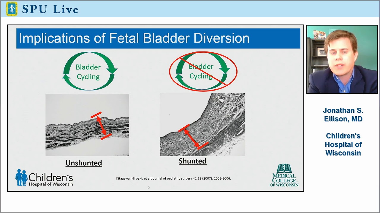 SPU Live: What is the Best Postnatal Surgical Intervention for Posterior Urethral Valves?