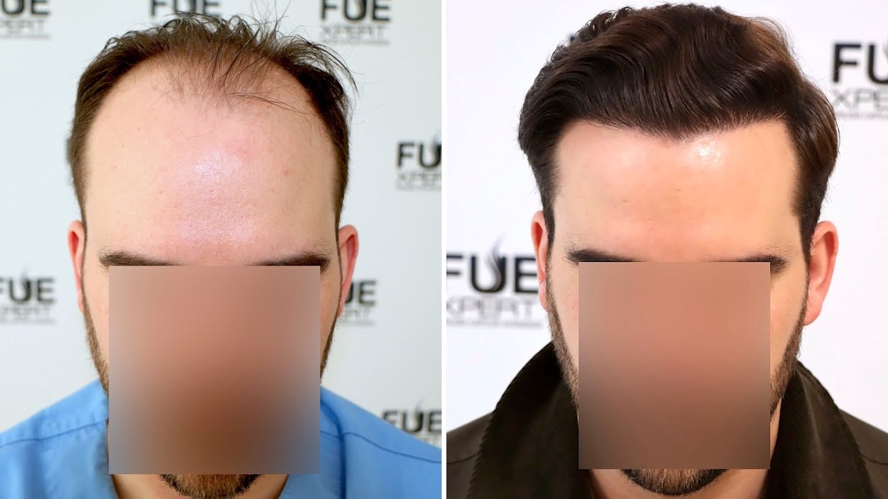 Trasplante Capilar FUE de 3100 injertos por el Dr. Juan Couto en FUEXPERT CLINIC - Madrid, España