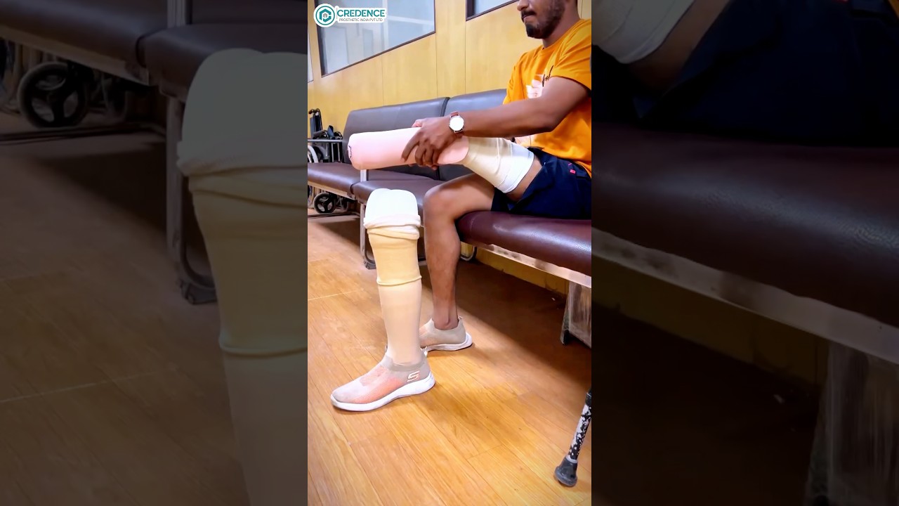 Price of Artificial Leg in India | 20,000 | Padeline Liner | Credence Prosthetic India | #ossurindia