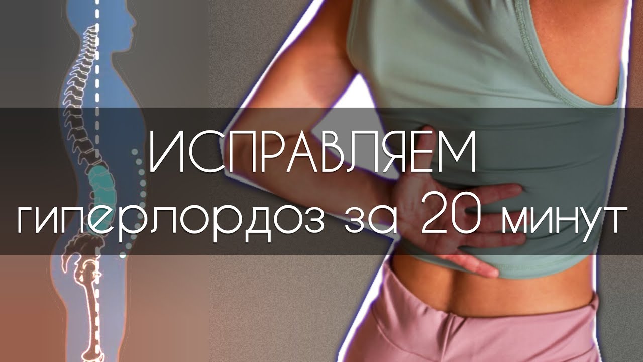Как исправить гиперлордоз? Упражнения от БОЛИ В ПОЯСНИЦЕ. 