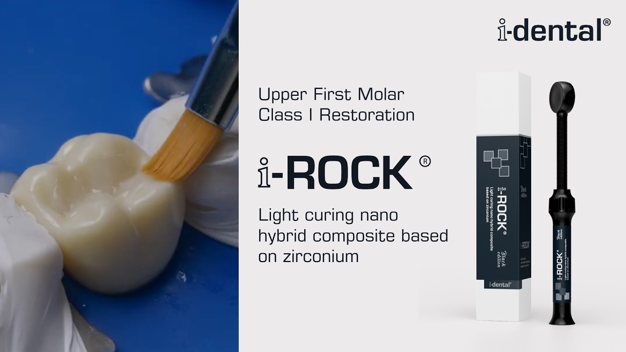 i-ROCK  |  LC Nano Hybrid Composite Based On Zirconium | Upper First Molar Class I Restoration