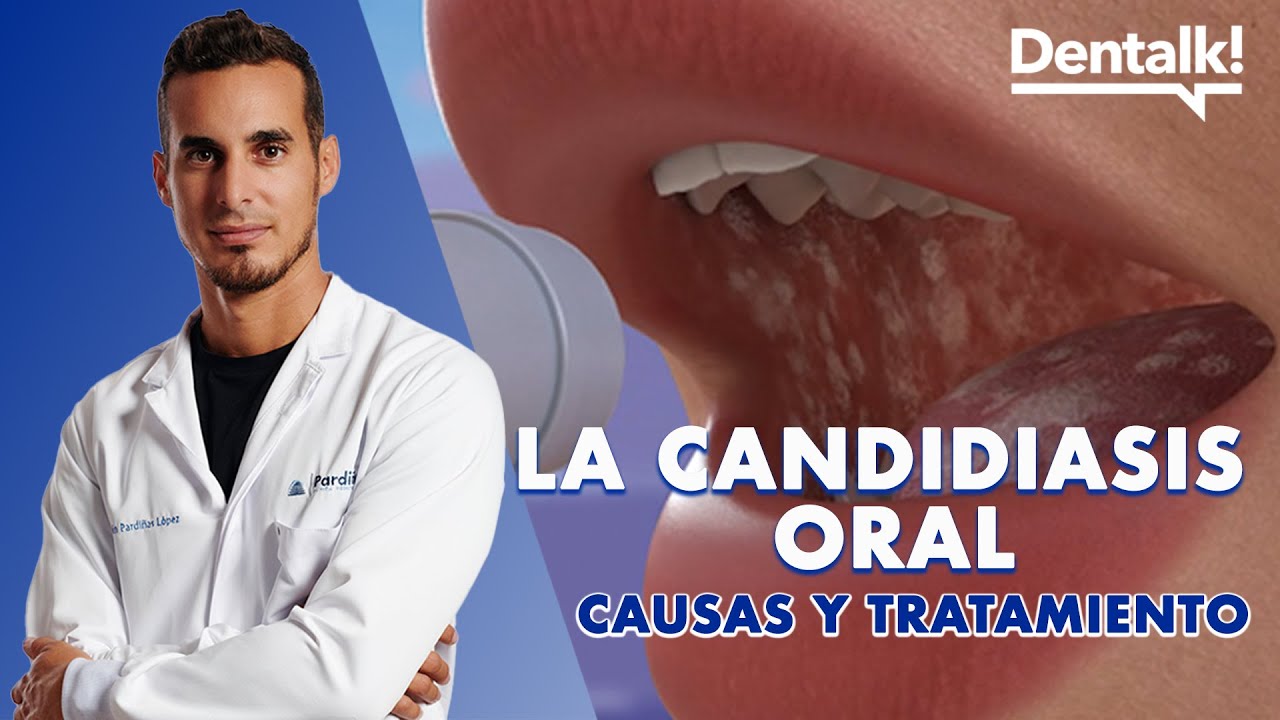 &iquest;HONGOS en la BOCA? Causas, prevenci&oacute;n y tratamiento de la CANDIDIASIS oral y BOQUERAS | Dentalk! &copy;