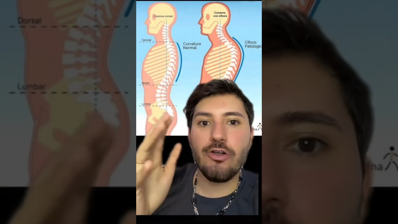 Tienes joroba, Hipercifosis dorsal o espalda curva? #fit #espalda #gym #fitness #ejercicio #joroba