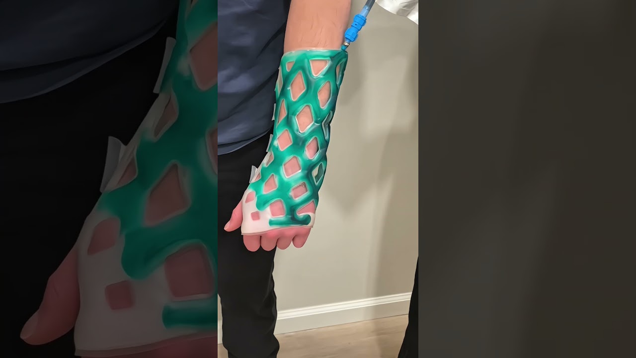 Un soporte para lesiones m&aacute;s ligero que el yeso😲