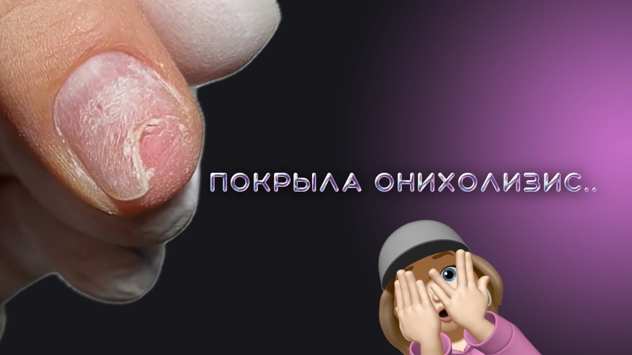 тот самый онихолизис и что я с ним делаю