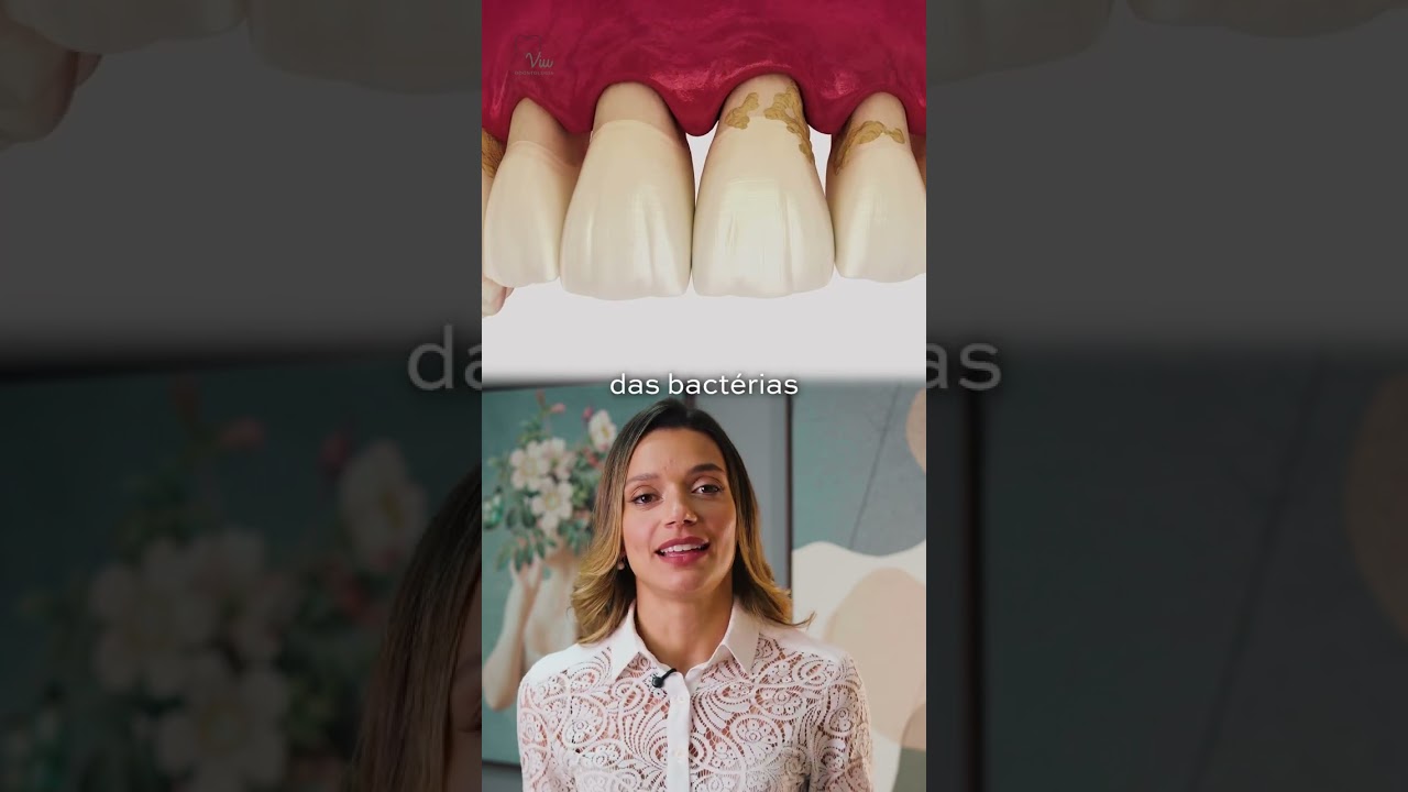 DIFEREN&Ccedil;A ENTRE PERIODONTITE E GENGIVITE