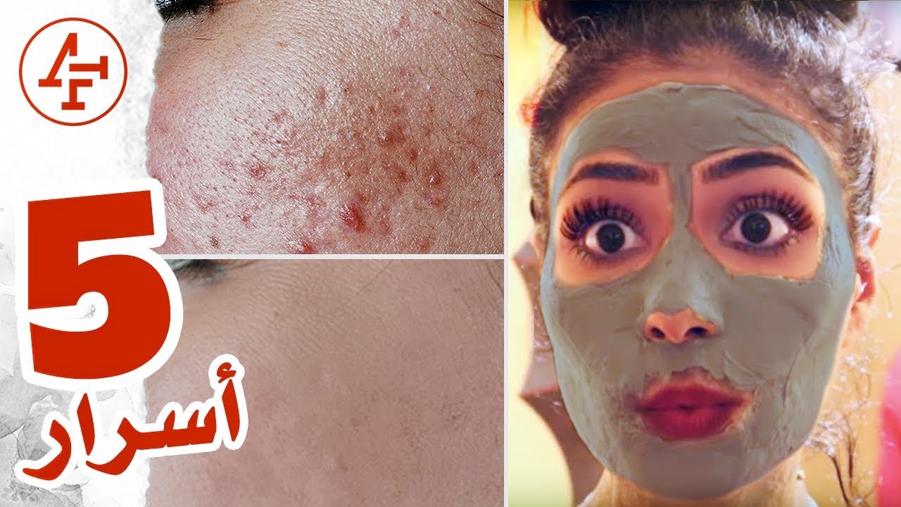 كيف ازيل حب الشباب وآثاره نهائياً - How to Git Rid of Acne