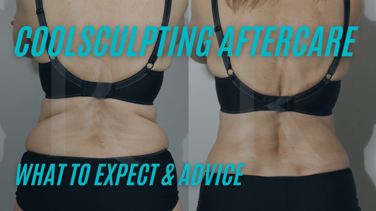 Coolsculpting Aftercare: What to Expect and Advice