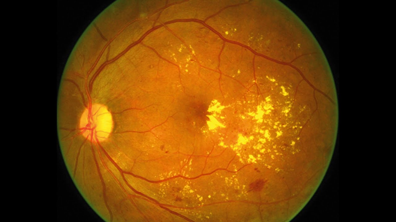 Gözdə sarı nöqtə xəstəliyi nədir?