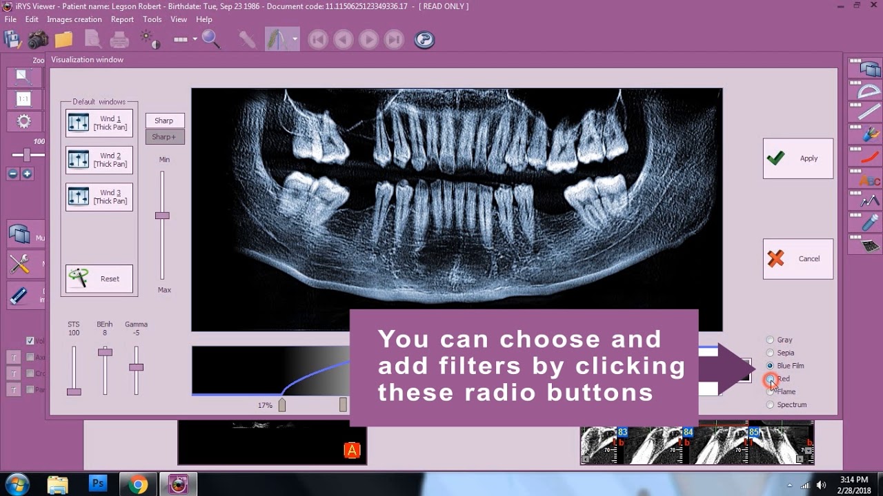 Insights Diagnostic - iRys Software Tutorial Video - 3D Image Enhancement