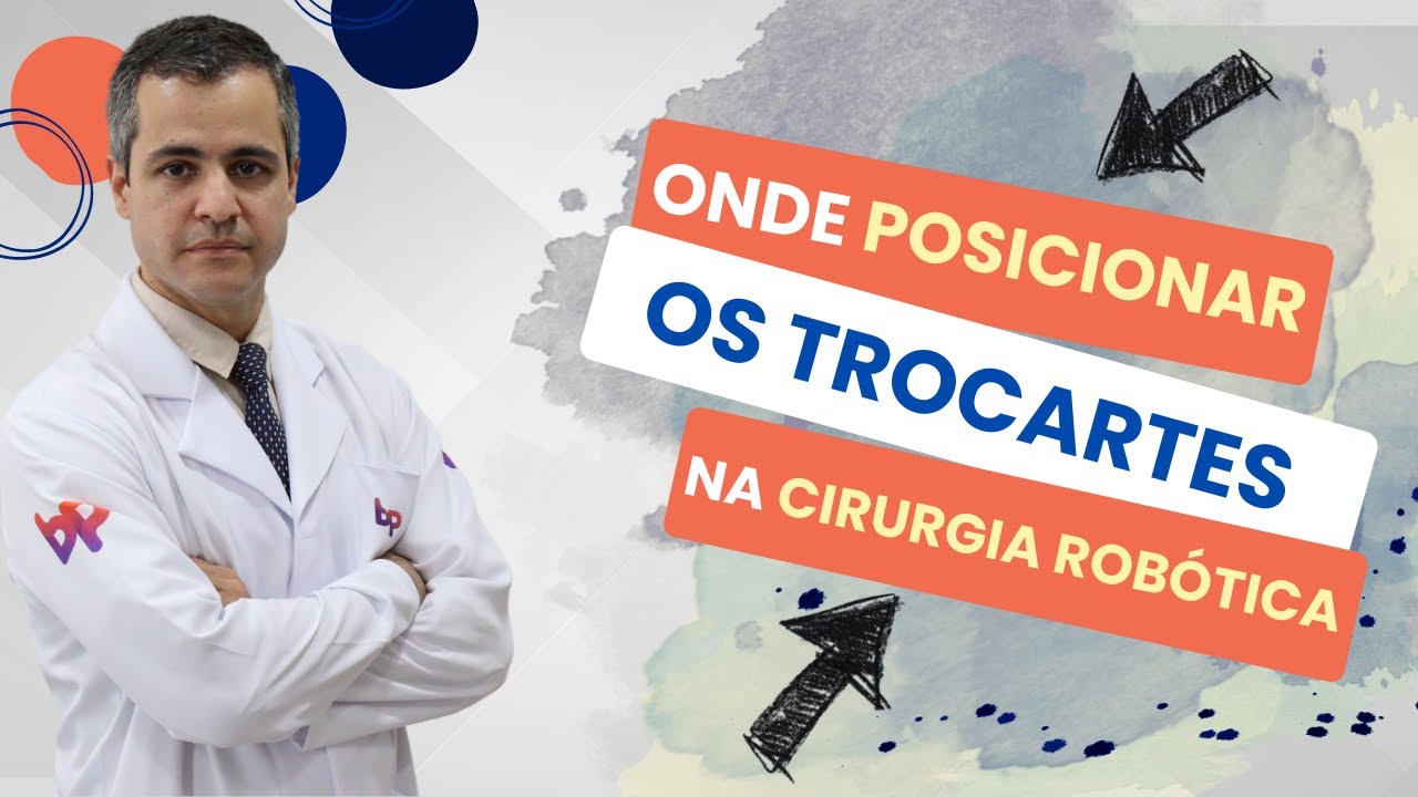 ONDE POSICIONAR OS TROCARTES NA CIRURGIA ROBÓTICA
