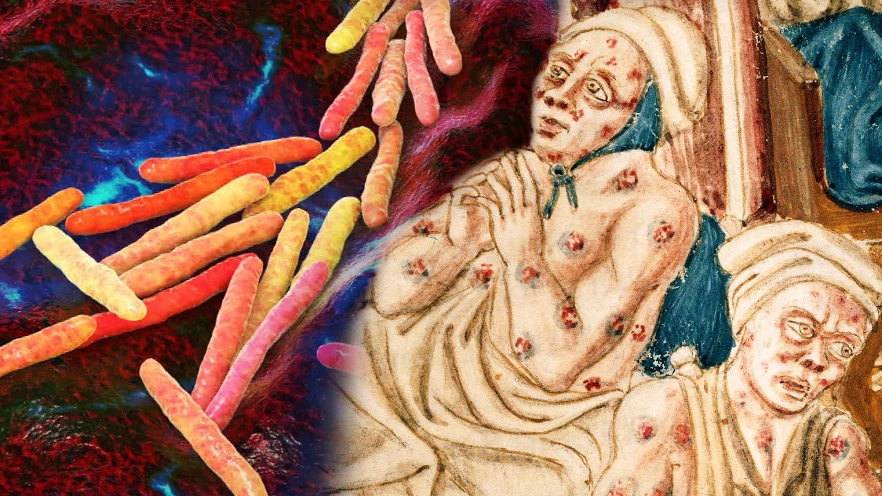 Should You Be Worried About Leprosy?
