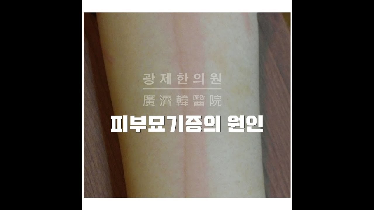 피부묘기증의 원인에 대해