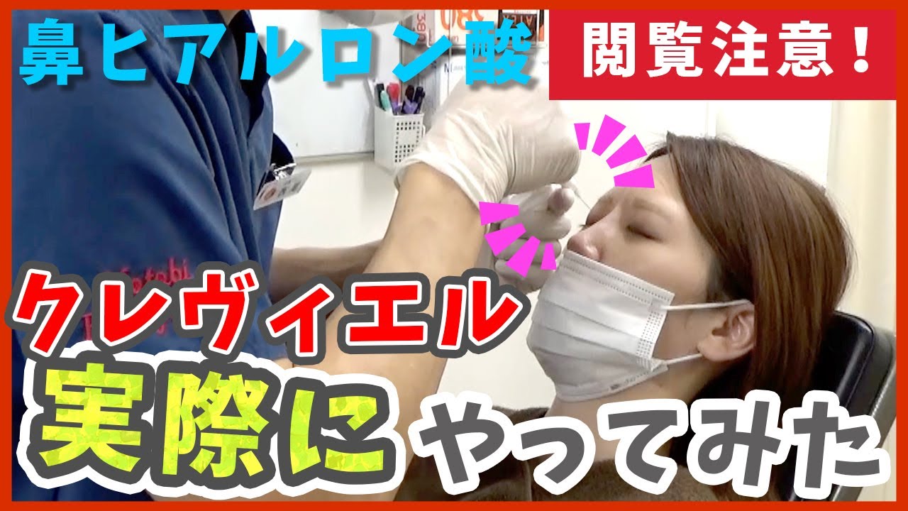 鼻のヒアルロン酸（クレヴィエル）の注入施術動画を公開します！【症例写真付き】