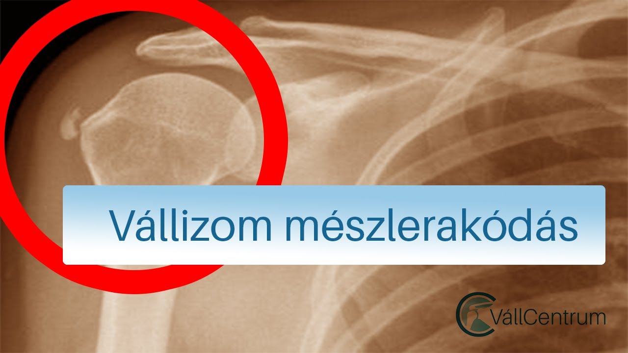 Vállizom mészlerakódás - Dr. Gulyás Károly vállsebész