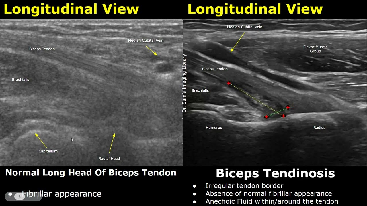 Elbow Ultrasound Normal Vs Abnormal Images | Muscles, Tendons, Ligaments and Nerves MSK USG