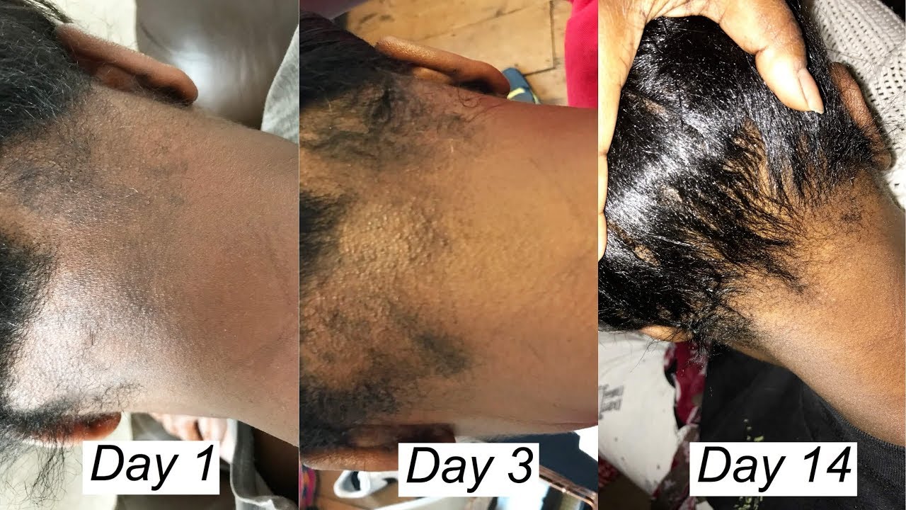 How I grew my edges in 10 days| how I made the products work effectively for me| fast results