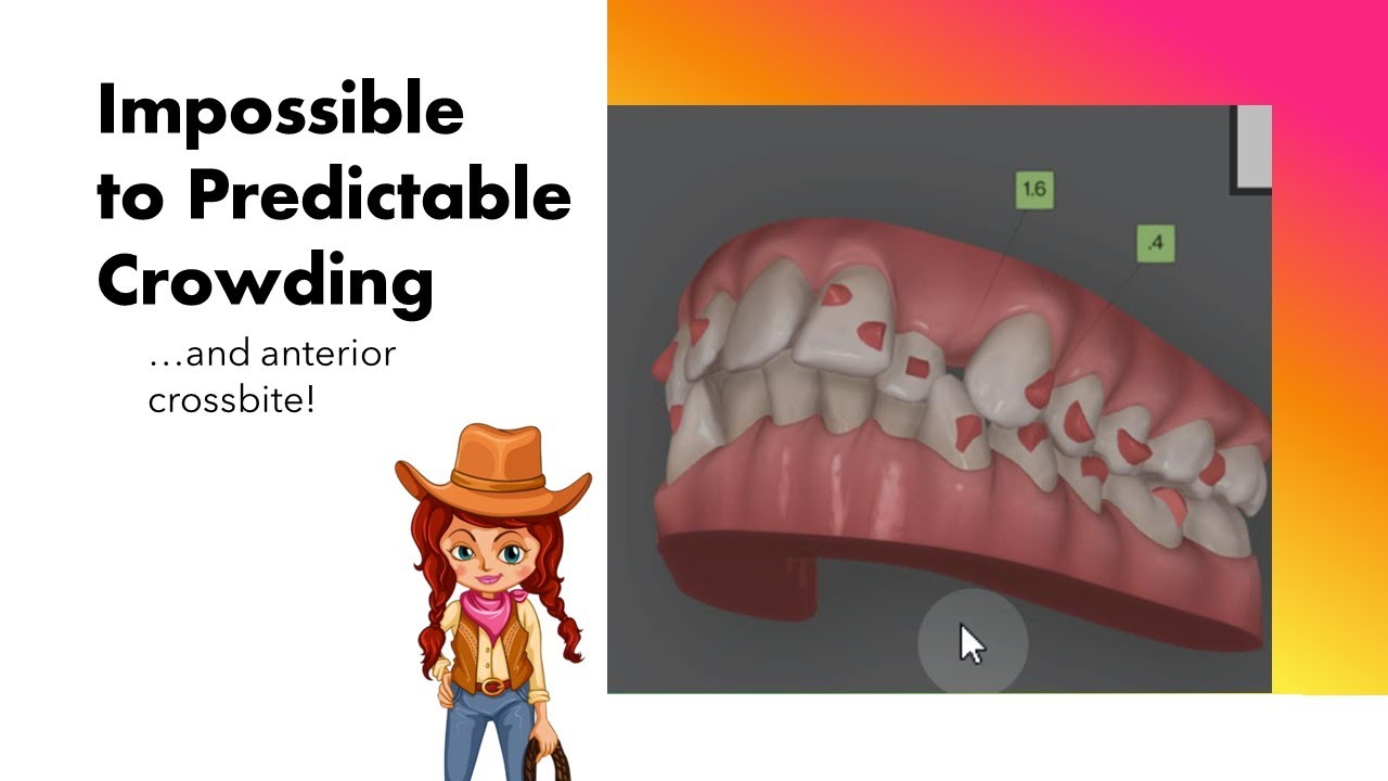 Invisalign ClinCheck - Impossible to Predictable crowding and crossbite!