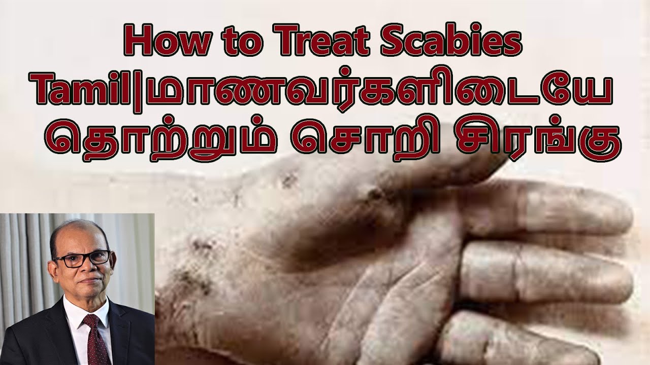 How to Treat Scabies Tamil |மாணவர்களிடையே தொற்றும் சொறி சிரங்கு| Prevent Scabies| Dr.Riyaz Majeed