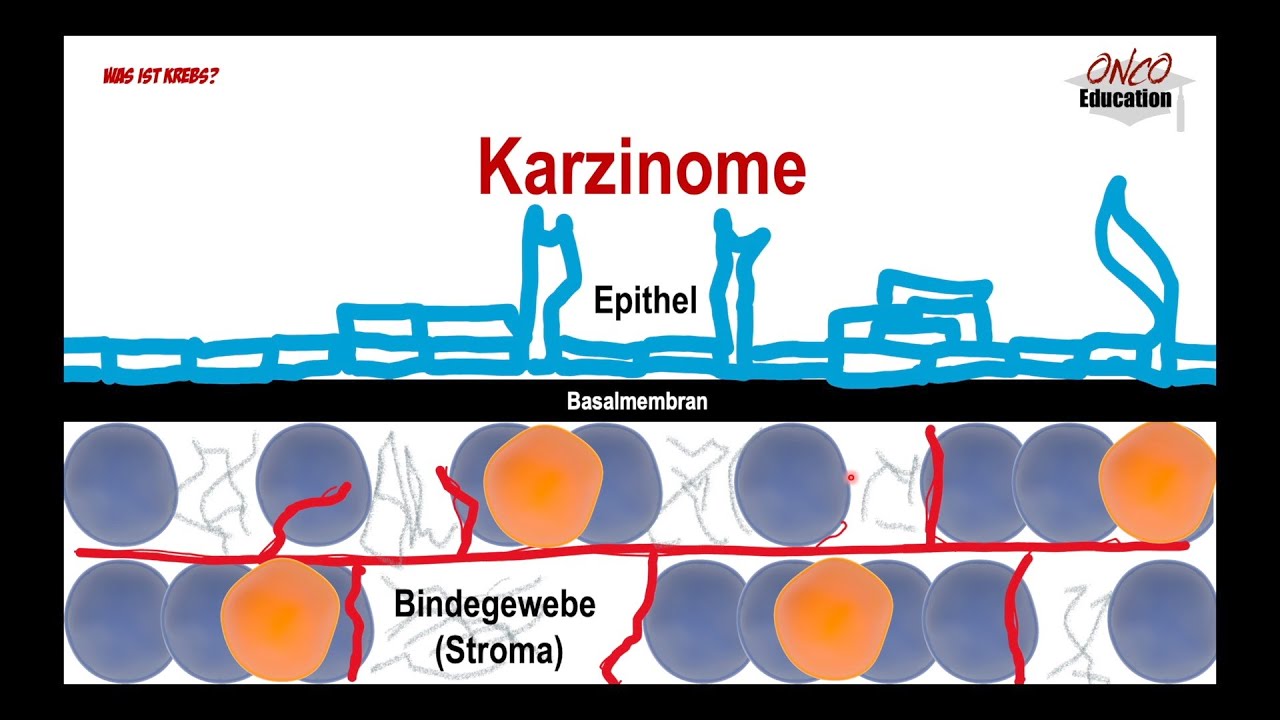 Krebsarten - Karzinome, Sarkome etc.