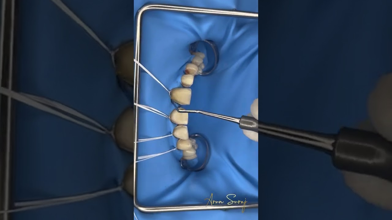Rubberdam isolation for veneer bonding