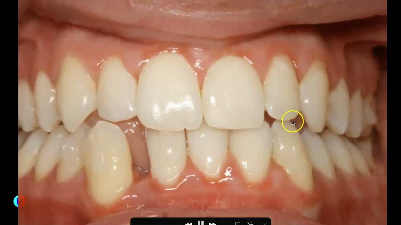 Cas d'extraction d'une seule incisive inférieure
