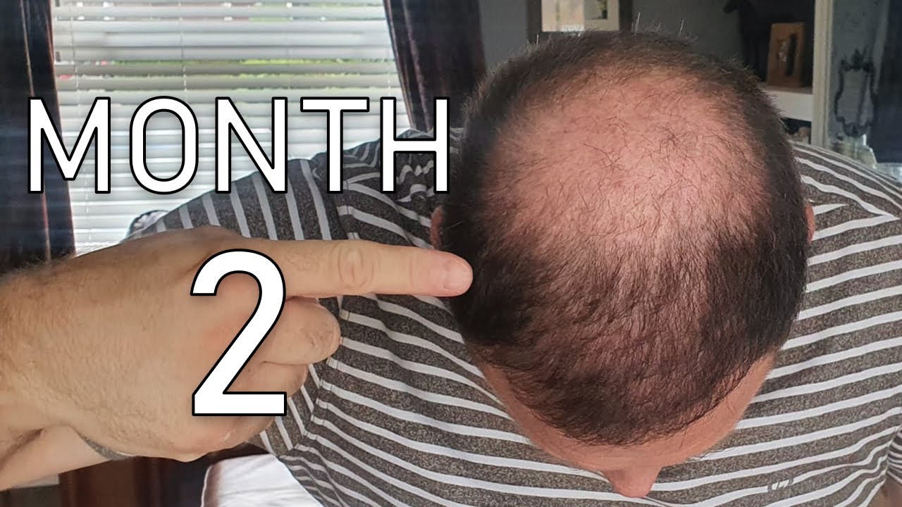 Month 2 - My Hair Transplant Journey 2.0 With ElitHair Istanbul and Dr Balwi
