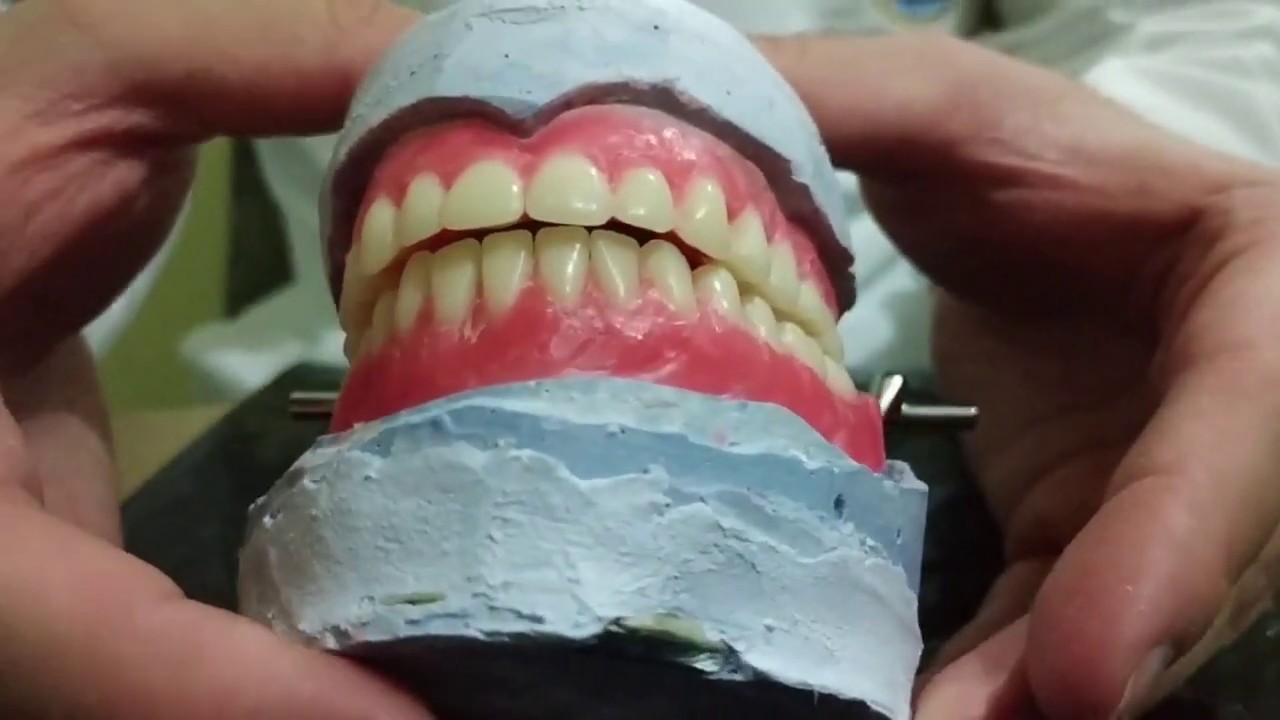 Enfilado de dientes artificiales en prótesis total (2/2)