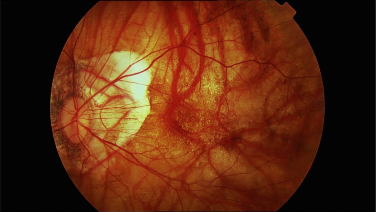 Miopía simple y degenerativa