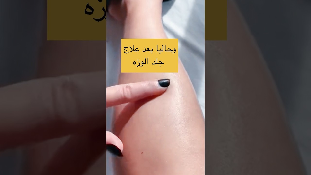 تجربتي مع الليزر المنزلي ومميزاته وعيوبه معايا