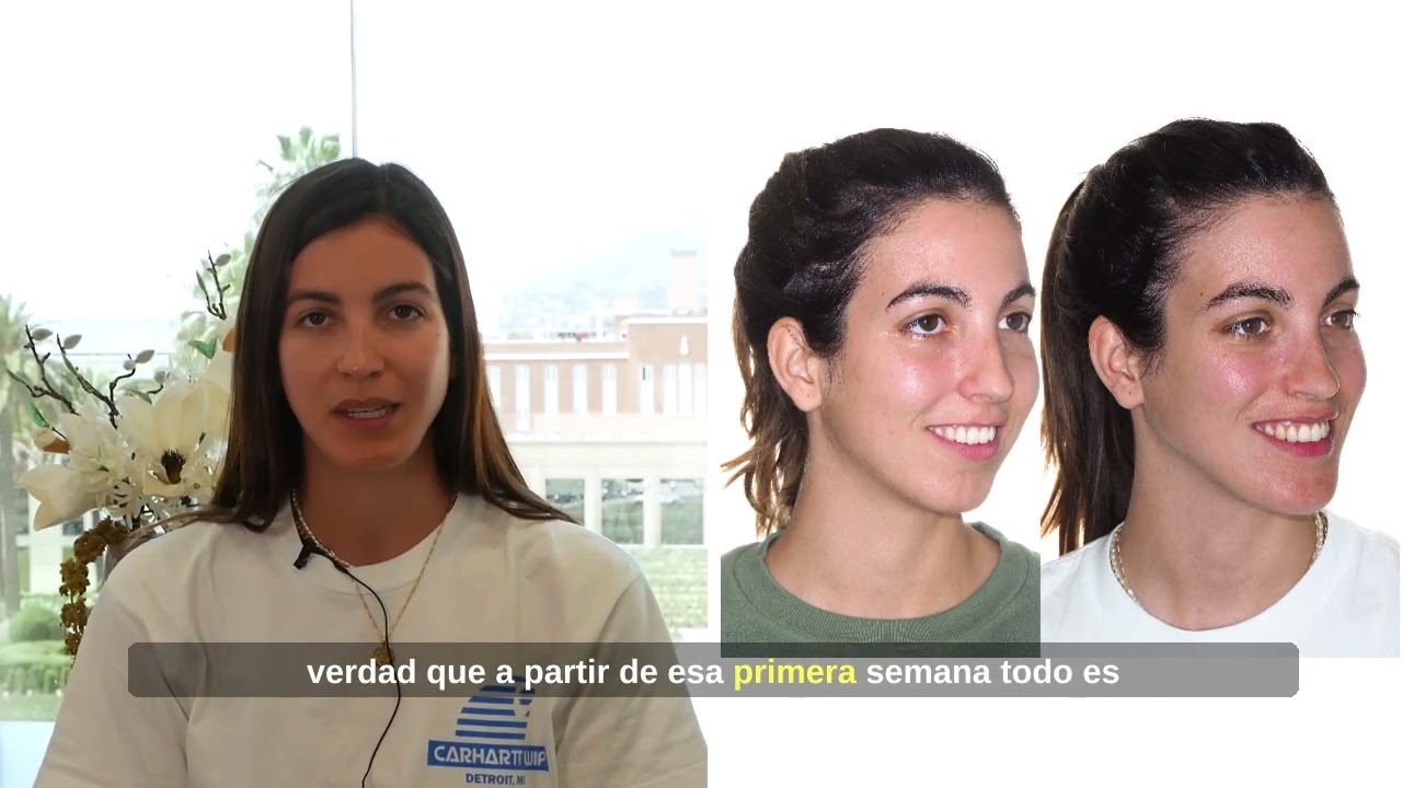 Cirug&iacute;a bimaxilar Caso #129: Paloma - Mordida abierta severa, retrusi&oacute;n maxilo-mandibular