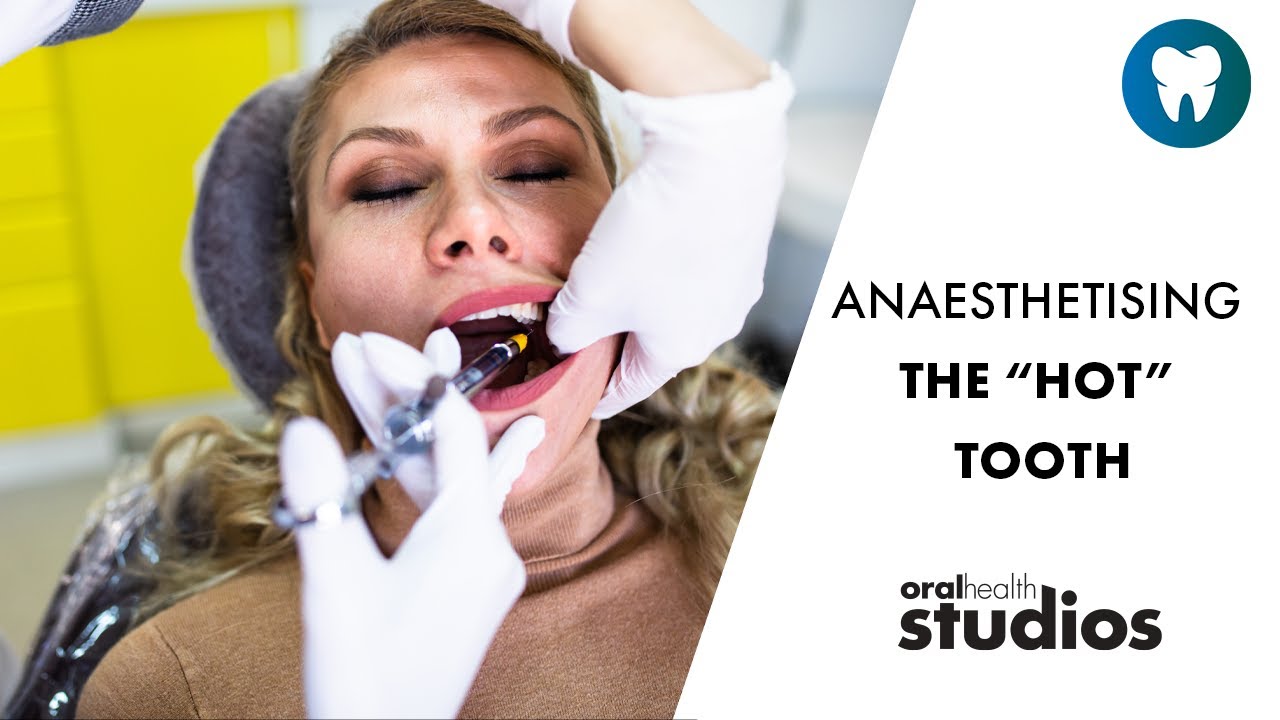 Anaesthetising the &ldquo;Hot&rdquo; Tooth | Weekly Wisdom 🦷