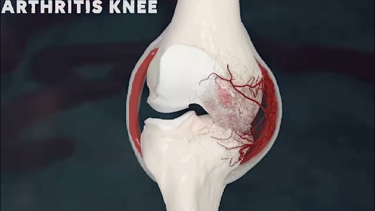 Genicular Artery Embolization (GAE)