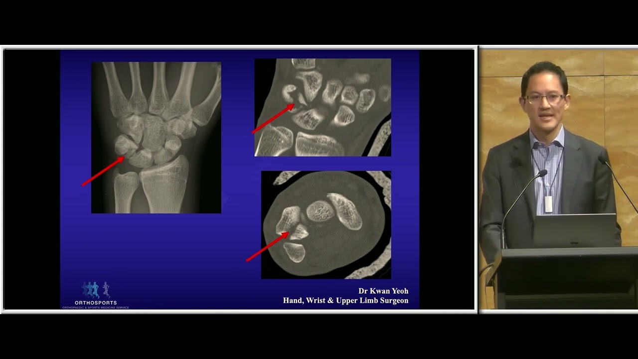 2023 05 Ulnar sided wrist pain - Dr Kwan Yeoh