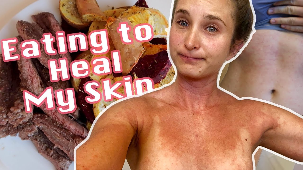 Skin Update + What I Eat for Healthy Skin | 5 MONTHS TOPICAL STEROID WITHDRAWAL