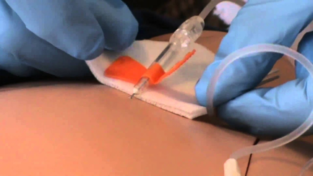 Injecteren Vleugelnaald