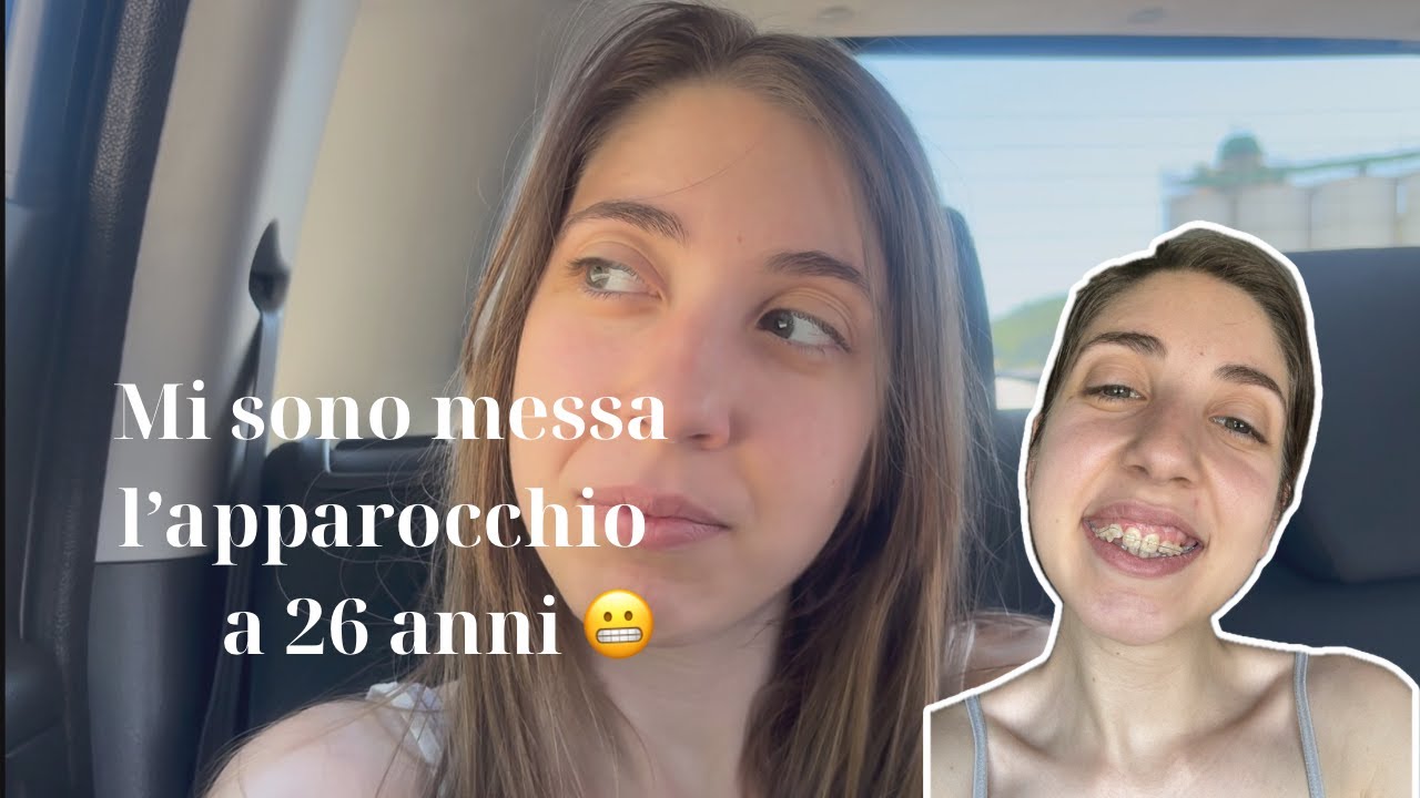 Non sono al mare ma dal dentista: ho messo l’apparecchio a 26 anni! 😬