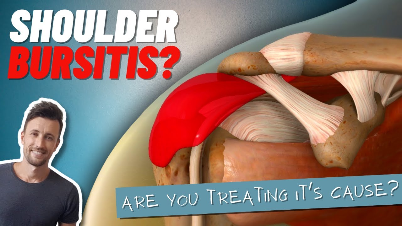 Persistent Shoulder Bursitis? Try THIS!