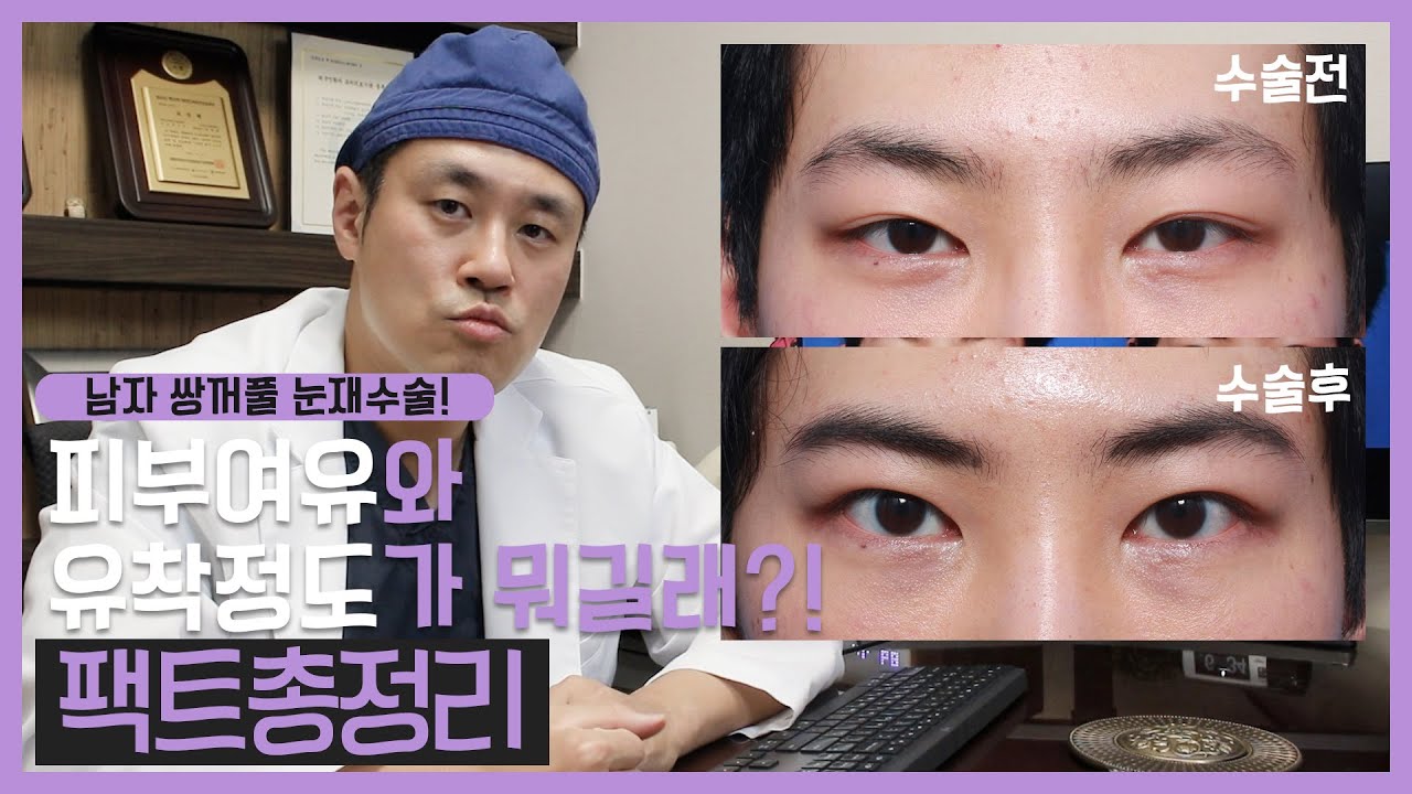 남자 쌍꺼풀 눈재수술, 피부여유분과 유착정도가 뭐길래?! 팩트 총정리