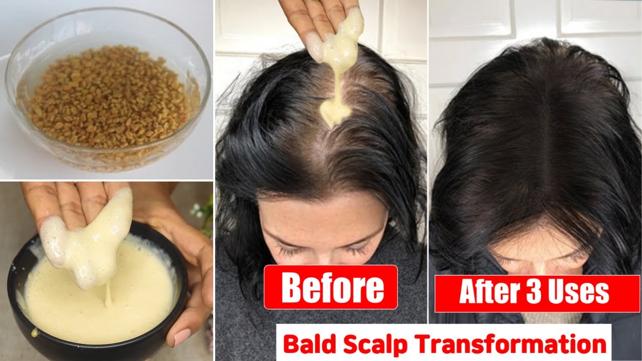 Apply👆🏼Methi Like This on Bald Scalp-Get Thick Fuller Hair Growth in 3 Use-Bald Scalp Transformation