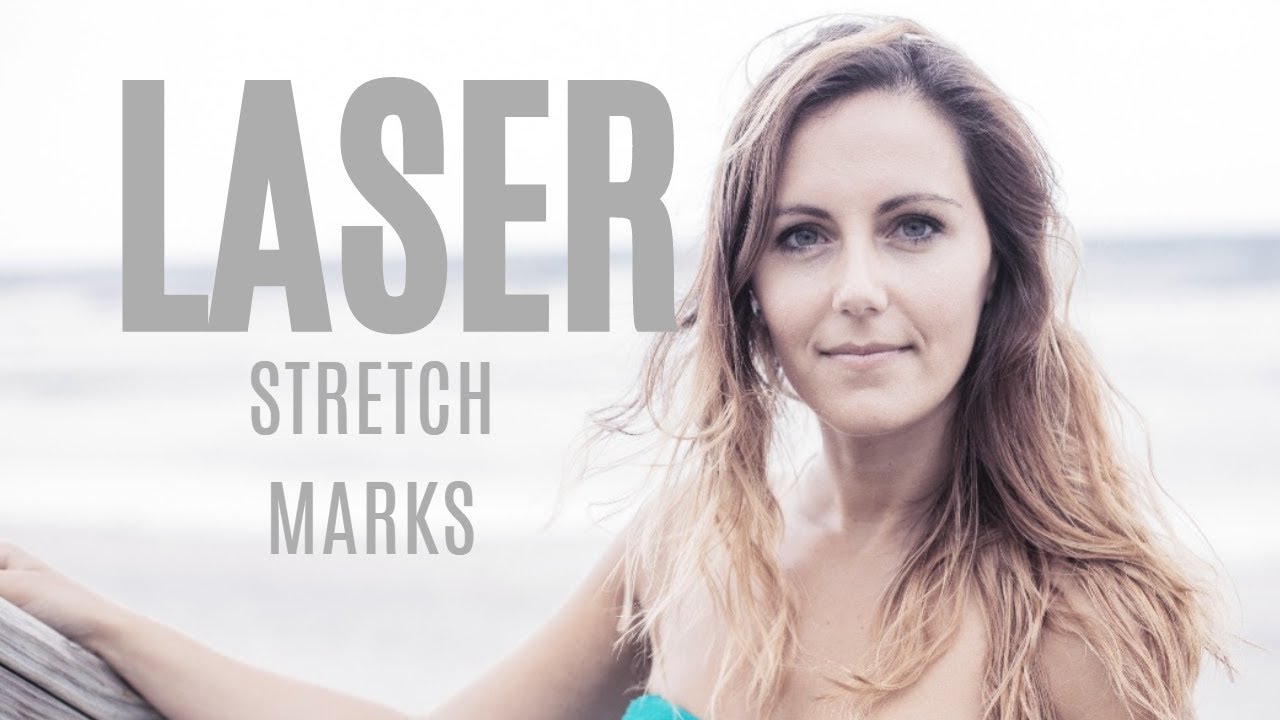 How-to: Stretch Mark Removal With Laser Treatment