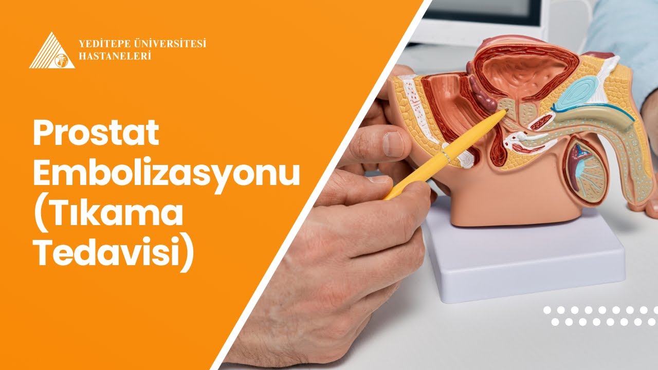 Prostat Embolizasyonu (Tıkama Tedavisi) | Doç. Dr. Melih Topçuoğlu