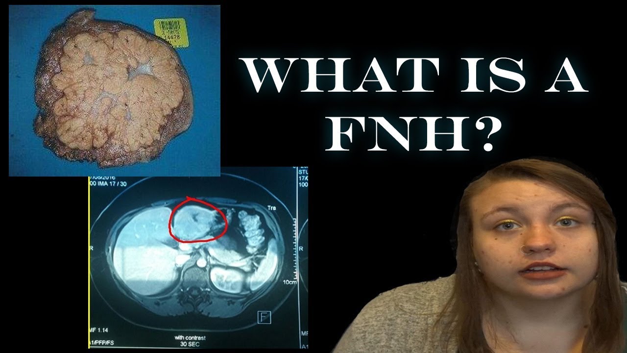 Focal Nodular Hyperplasia Information