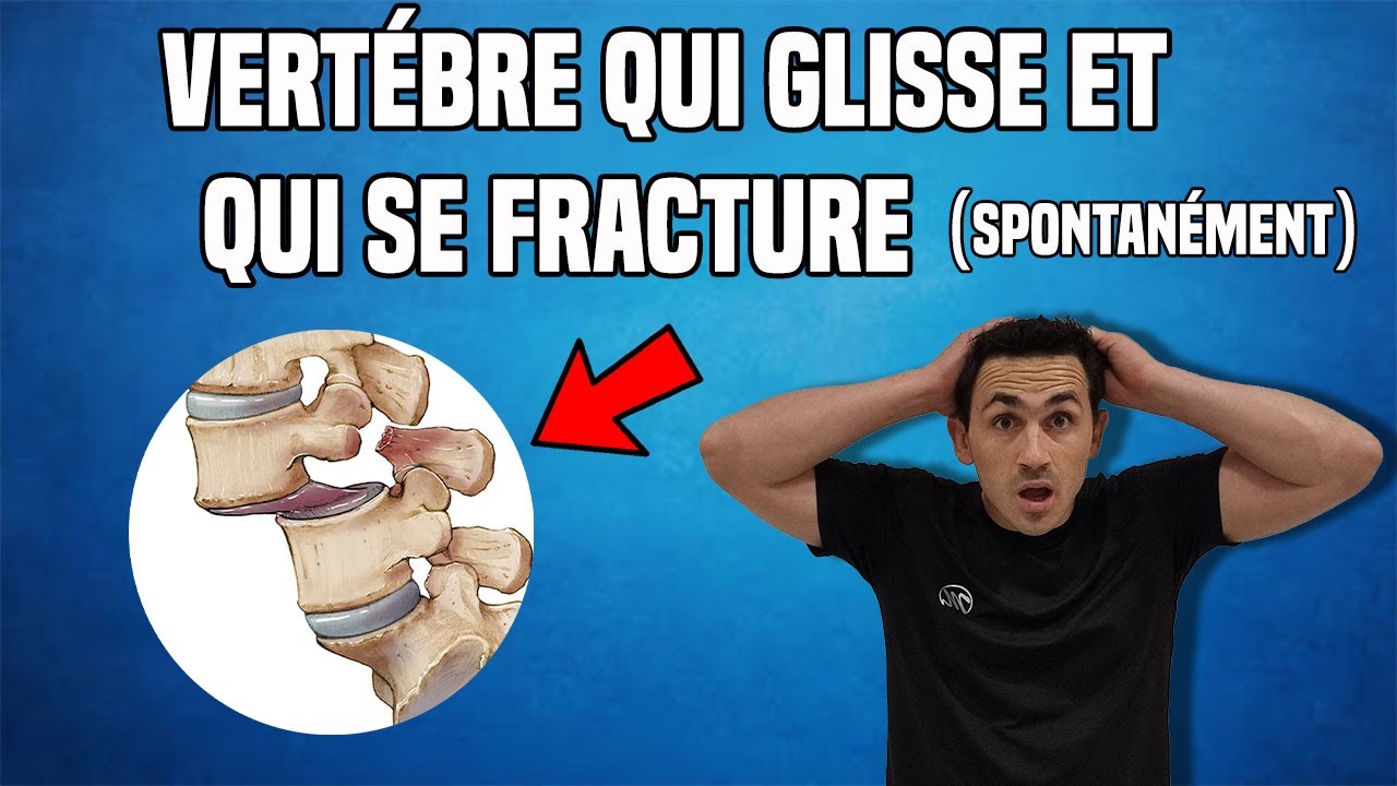 TRAITEMENT DU SPONDYLOLISTHÉSIS LOMBAIRE : EXERCICE KINÉ