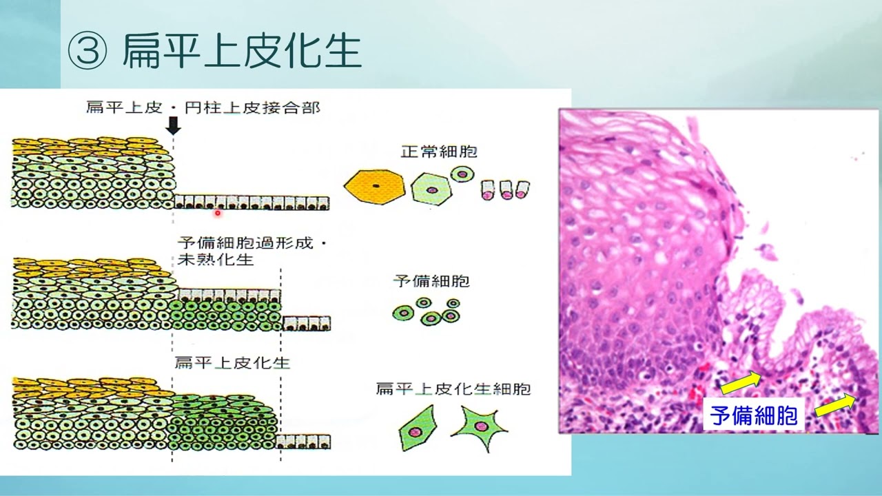 細胞診断学（婦人科1）（関西医療大学　矢野恵子）