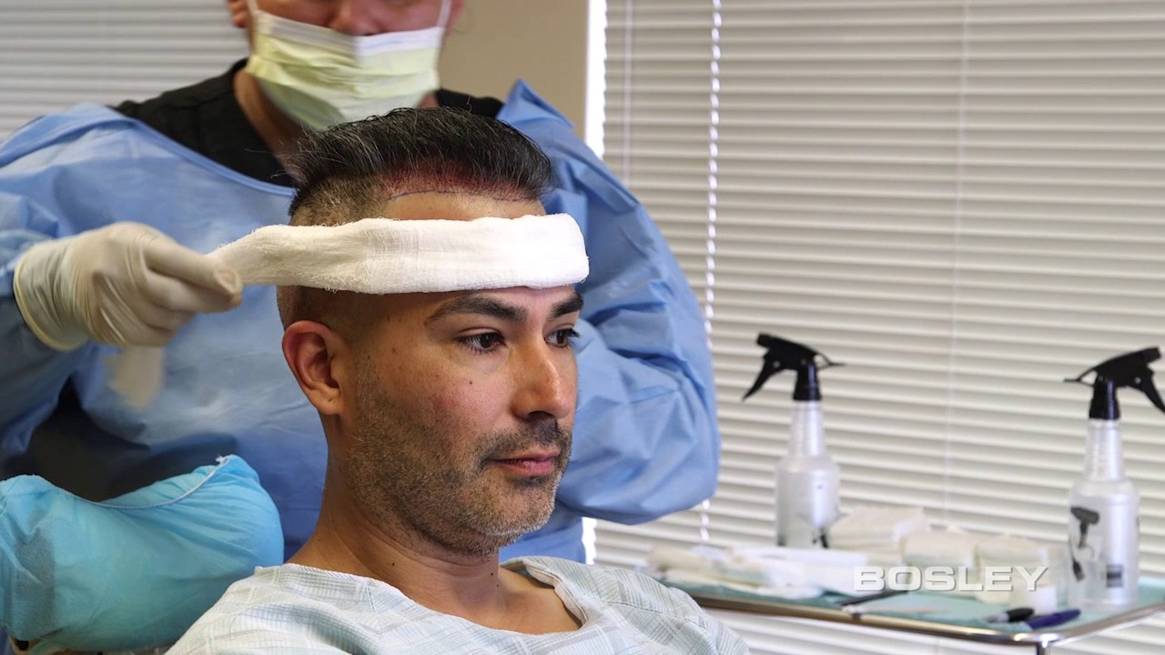Hair-by-Hair&reg; Restoration: Edgar&rsquo;s FUE Success Story