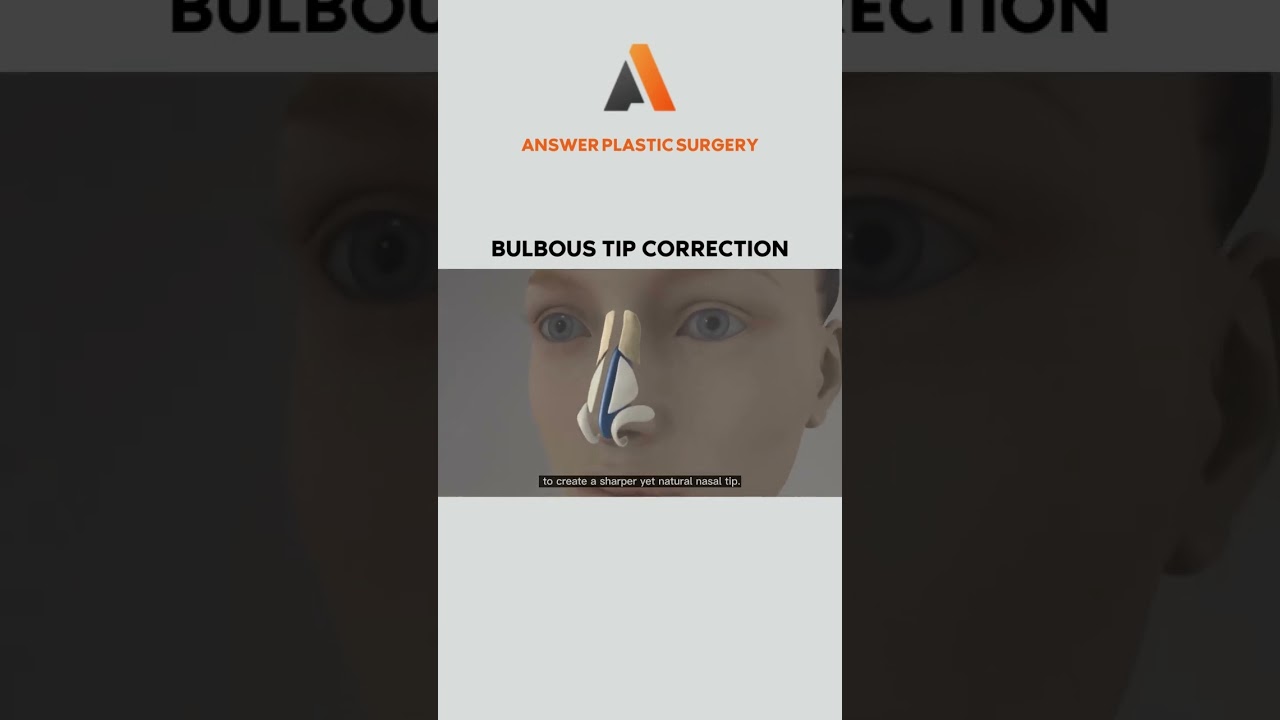 Bulbous Tip Correction | Answer Plastic Surgery #shorts #bulboustipcorrection