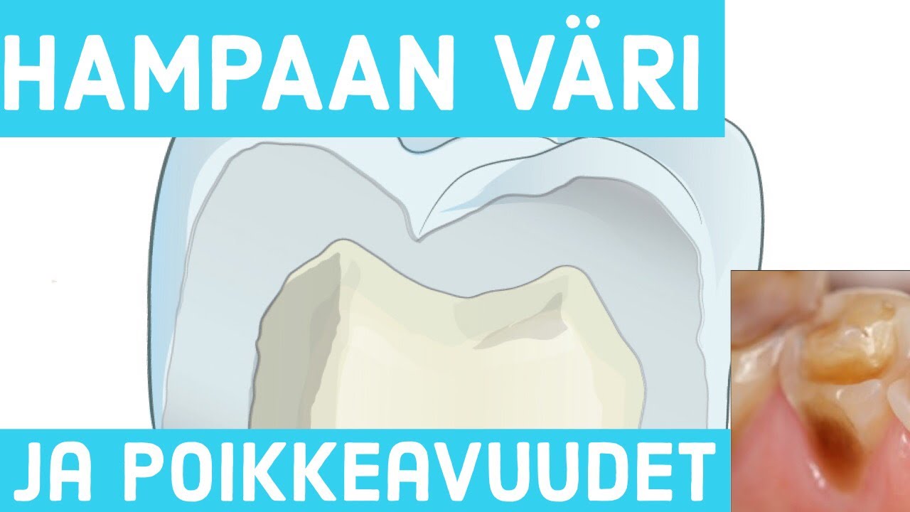Hampaan väri ja hampaan värjäymät - Hammaslääkäri kertoo
