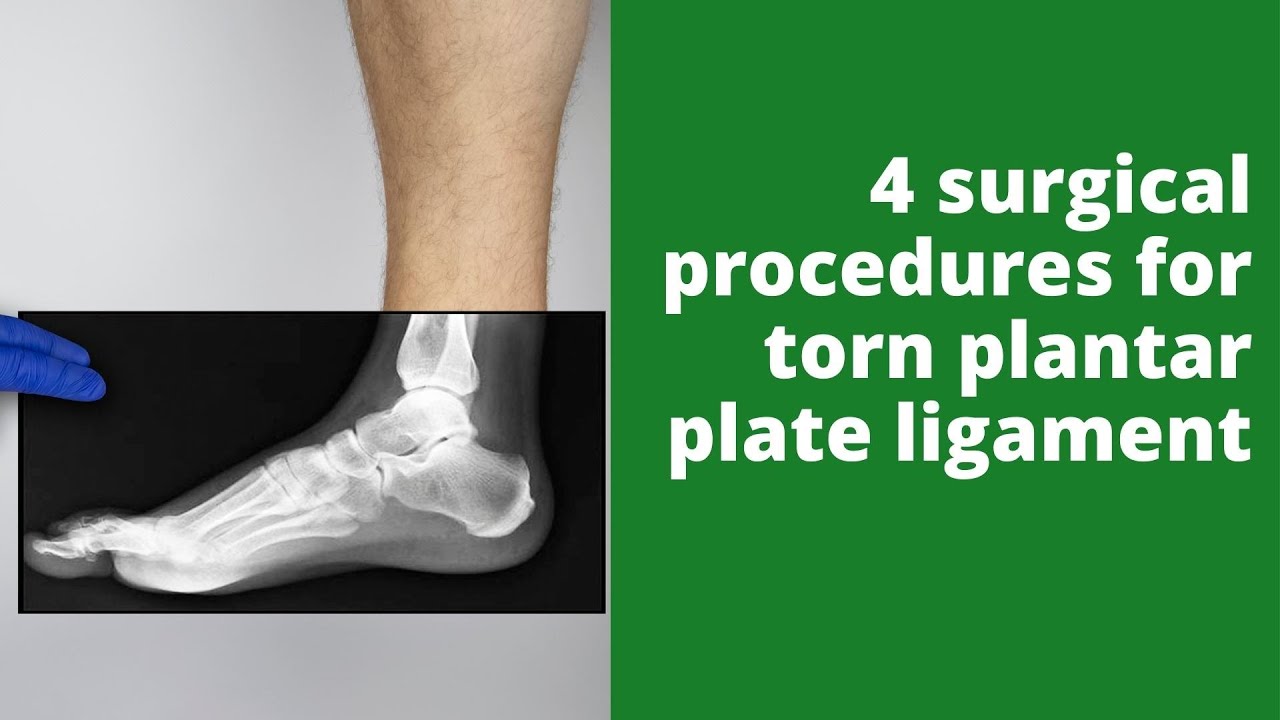 4 surgical procedures for torn plantar plate ligament