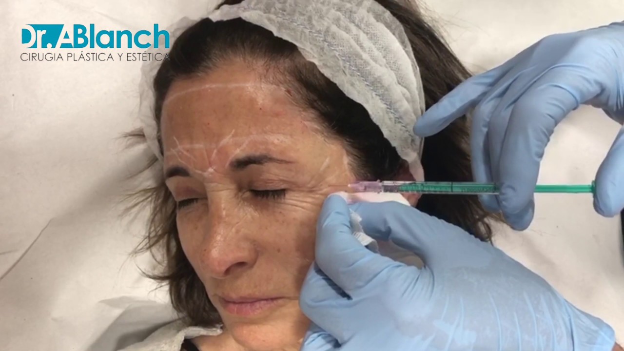 Todo lo que Necesitas Saber sobre el Bótox | Anatomía Facial y Aplicación